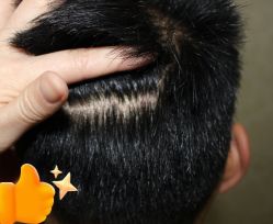 -大麦微针植发丨全国连锁