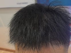 -碧莲盛·不剃发植发