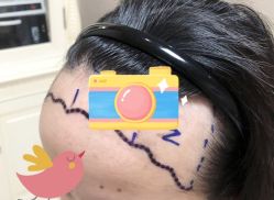 -大麦微针植发全国连锁