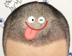 -大麦微针植发全国连锁