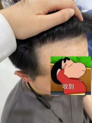 体验后-大麦微针植发全国连锁