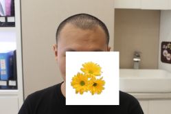 -大麦微针植发丨全国连锁