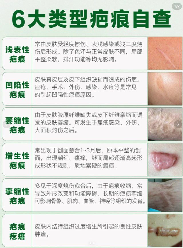 6大疤痕类型自查
✅浅表性疤痕: 原