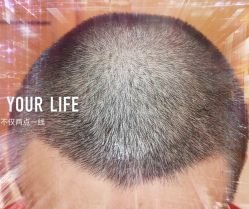 -大麦微针植发全国连锁