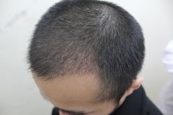 点击看大图 -大麦微针植发丨全国连锁