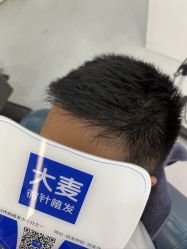 点击看大图 体验后-大麦微针植发全国连锁