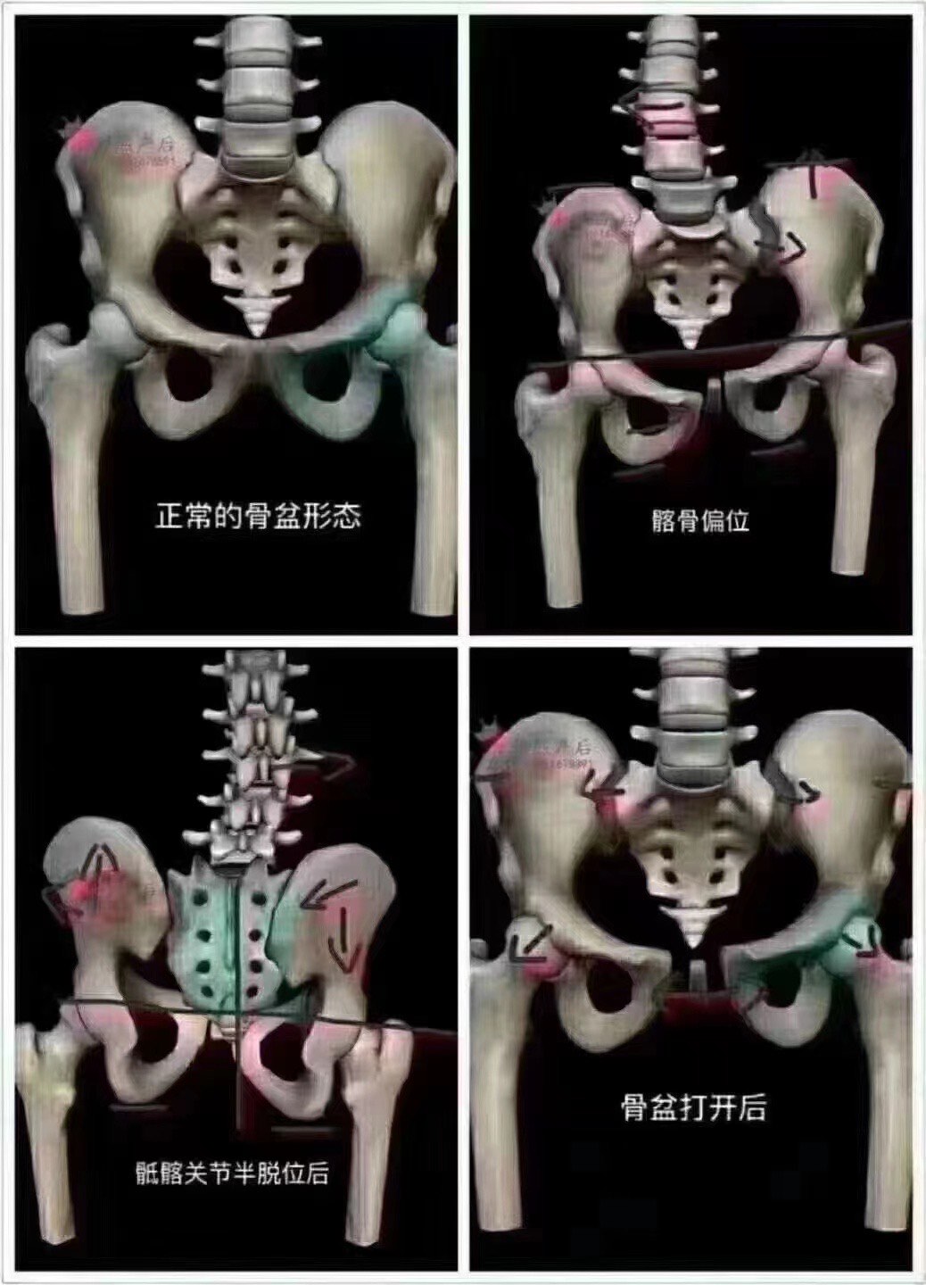 盆骨宽怎么变窄图片