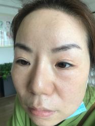 -爱莎扁平疣·汗管瘤·斑痣中心