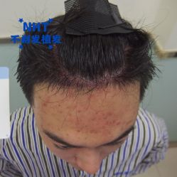 -碧莲盛·不剃发植发