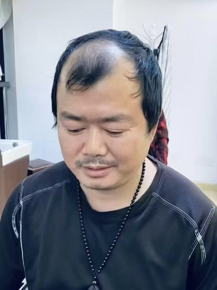 n可现实生活里的我,就是个普通秃顶大叔😅.地中海