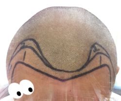 -大麦微针植发全国连锁