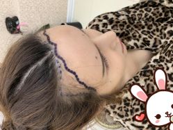 点击看大图 -大麦微针植发丨全国连锁