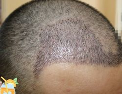 -大麦微针植发丨全国连锁