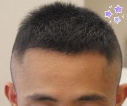 -大麦微针植发丨全国连锁