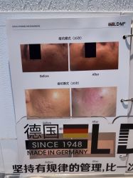 -小梨·OndaPro·专业脱毛连锁机构