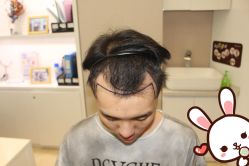 点击看大图 -大麦微针植发丨全国连锁