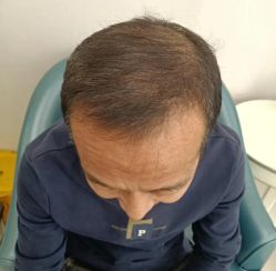 -大麦微针植发丨全国连锁