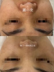 -塑青春&伊肤泉祛痘皮肤管理