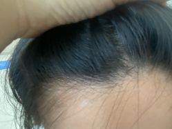体验后-大麦微针植发丨全国连锁