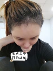 -大麦微针植发全国连锁