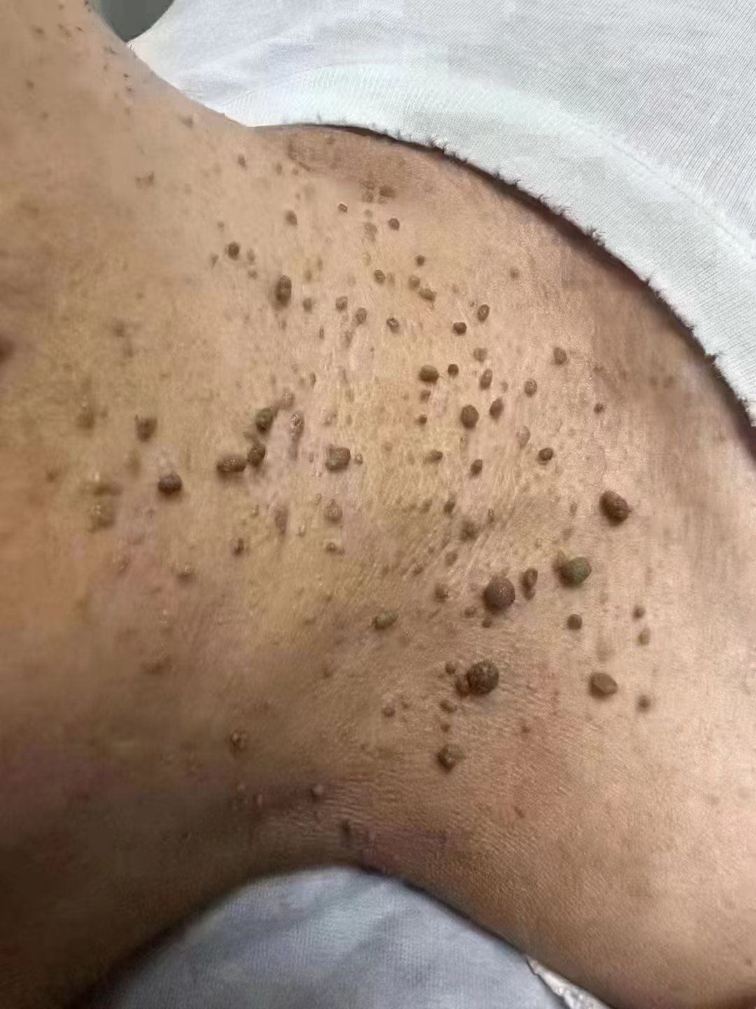 疣!一个小小的小东西,却可能引发大范围