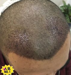 -大麦微针植发丨全国连锁