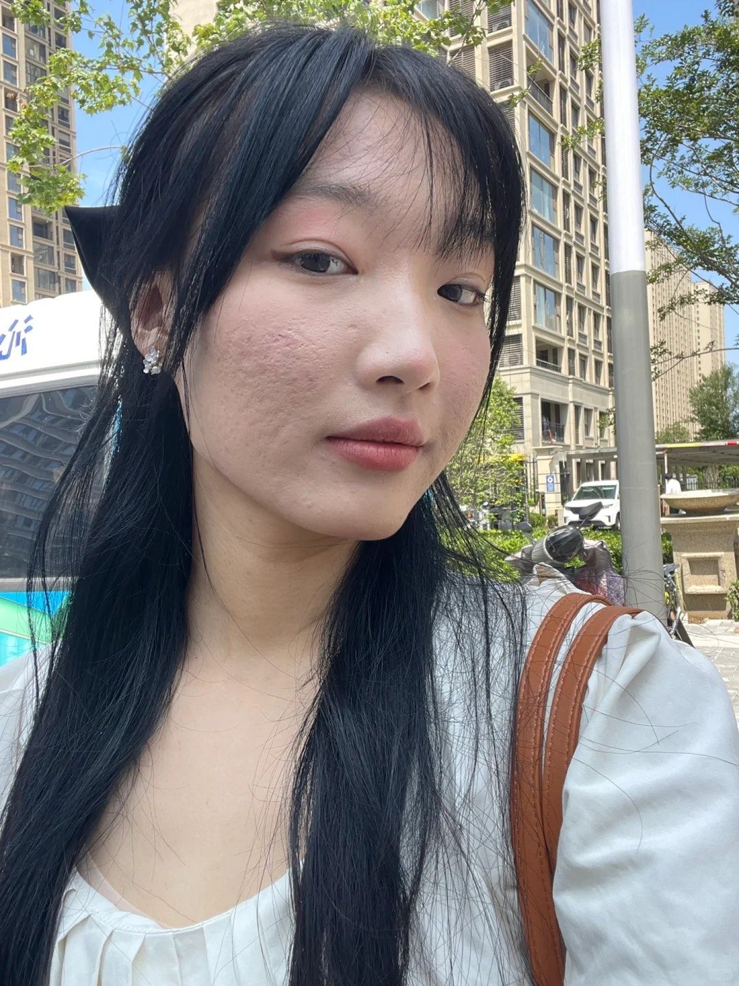 n我是从青春期开始爆痘,当时无所谓,以至于现在留下了很多痘坑痘印!