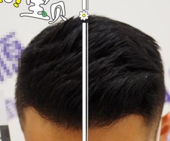 -大麦微针植发全国连锁