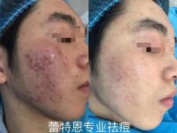-蕾特恩专业祛痘·皮肤管理