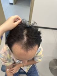 -大麦微针植发全国连锁