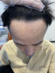 -大麦微针植发全国连锁