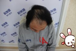 -大麦微针植发丨全国连锁