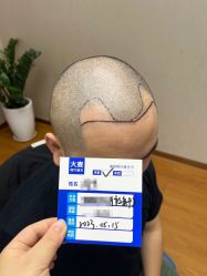 -大麦微针植发全国连锁