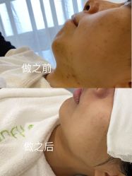-塑青春&伊肤泉祛痘皮肤管理