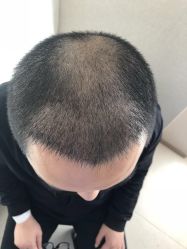 点击看大图 -大麦微针植发丨全国连锁