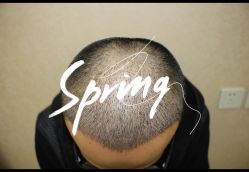 点击看大图 -大麦微针植发全国连锁