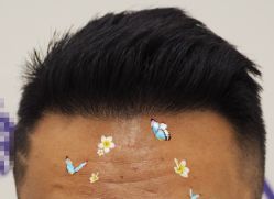 -大麦微针植发全国连锁