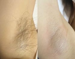 -薇兰专业脱毛连锁机构