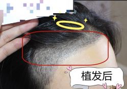 -大麦微针植发全国连锁