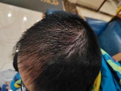 -碧莲盛·不剃发植发