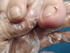 -祖传修脚甲沟炎灰指甲鸡眼