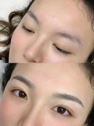 体验前-郡艺医疗美容·微整·眼鼻吸脂