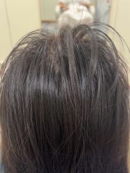 -碧莲盛·不剃发植发