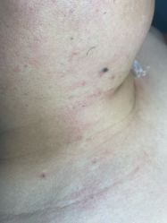 -爱莎扁平疣·汗管瘤·斑痣中心
