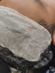 -碧莲盛·不剃发植发