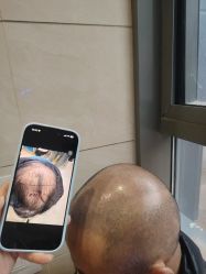 -碧莲盛·不剃发植发