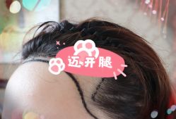 -大麦微针植发全国连锁