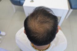 -大麦微针植发丨全国连锁