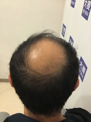 -大麦微针植发丨全国连锁