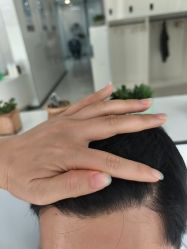 -大麦微针植发丨全国连锁